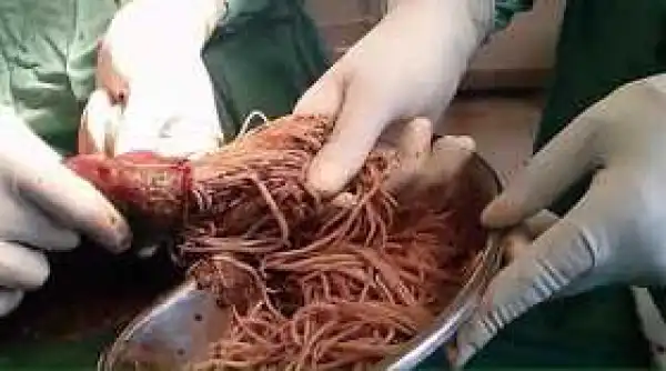 See Why You Should Avoid Eating Raw Or Undone Food. (Viewers Discretion)...